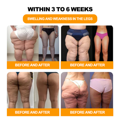 𝟑𝟎 𝐇𝐞𝐫𝐛𝐚𝐥 𝐋𝐲𝐦𝐩𝐡𝐚𝐭𝐢𝐜 𝐃𝐫𝐚𝐢𝐧𝐚𝐠𝐞 𝐖𝐞𝐢𝐠𝐡𝐭 𝐋𝐨𝐬𝐬 𝐁𝐞𝐚𝐝𝐬-👨‍⚕️👨‍⚕️𝗥𝗲𝗰𝗼𝗺𝗺𝗲𝗻𝗱𝗲𝗱 𝗯𝘆 𝘁𝗵𝗲 𝗕𝗿𝗶𝘁𝗶𝘀𝗵 𝗟𝘆𝗺𝗽𝗵𝗮𝘁𝗶𝗰 𝗦𝗼𝗰𝗶𝗲𝘁𝘆 (𝗟𝗦𝗡)