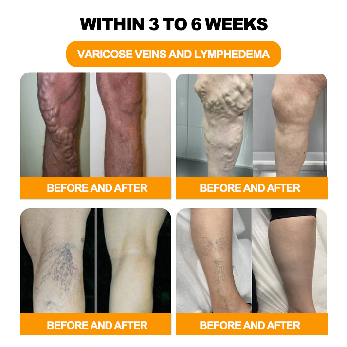 𝟑𝟎 𝐇𝐞𝐫𝐛𝐚𝐥 𝐋𝐲𝐦𝐩𝐡𝐚𝐭𝐢𝐜 𝐃𝐫𝐚𝐢𝐧𝐚𝐠𝐞 𝐖𝐞𝐢𝐠𝐡𝐭 𝐋𝐨𝐬𝐬 𝐁𝐞𝐚𝐝𝐬-👨‍⚕️👨‍⚕️𝗥𝗲𝗰𝗼𝗺𝗺𝗲𝗻𝗱𝗲𝗱 𝗯𝘆 𝘁𝗵𝗲 𝗕𝗿𝗶𝘁𝗶𝘀𝗵 𝗟𝘆𝗺𝗽𝗵𝗮𝘁𝗶𝗰 𝗦𝗼𝗰𝗶𝗲𝘁𝘆 (𝗟𝗦𝗡)