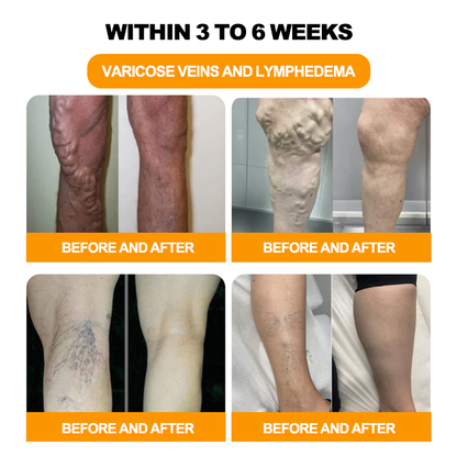 𝟑𝟎 𝐇𝐞𝐫𝐛𝐚𝐥 𝐋𝐲𝐦𝐩𝐡𝐚𝐭𝐢𝐜 𝐃𝐫𝐚𝐢𝐧𝐚𝐠𝐞 𝐖𝐞𝐢𝐠𝐡𝐭 𝐋𝐨𝐬𝐬 𝐁𝐞𝐚𝐝𝐬-👨‍⚕️👨‍⚕️𝗥𝗲𝗰𝗼𝗺𝗺𝗲𝗻𝗱𝗲𝗱 𝗯𝘆 𝘁𝗵𝗲 𝗕𝗿𝗶𝘁𝗶𝘀𝗵 𝗟𝘆𝗺𝗽𝗵𝗮𝘁𝗶𝗰 𝗦𝗼𝗰𝗶𝗲𝘁𝘆 (𝗟𝗦𝗡)